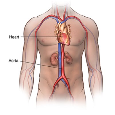 Aortic Aneurysm Treatment in Jaipur