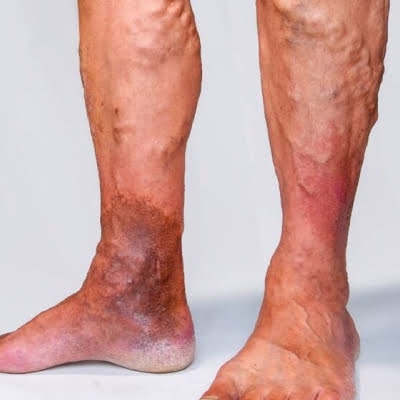 Get Varicose Veins Treatment in Jaipur