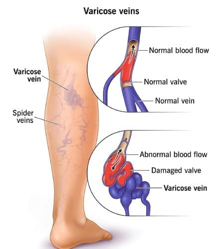Causes of Varicose Veins