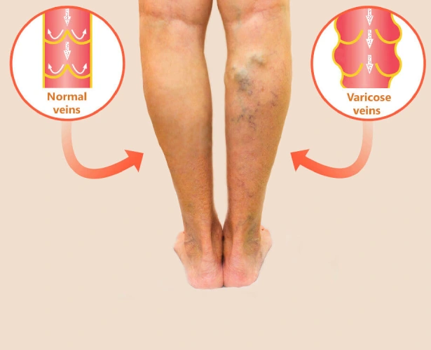 Symptoms of Varicose Veins