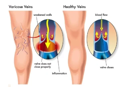 Treatment Options for Varicose Veins