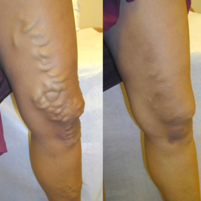 Get Varicose Veins Sclerotherapy in Jaipur