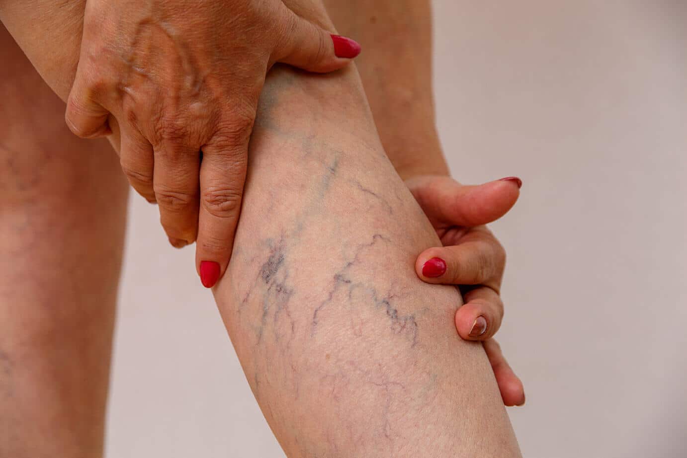 Varicose Veins by RFA in Jaipur