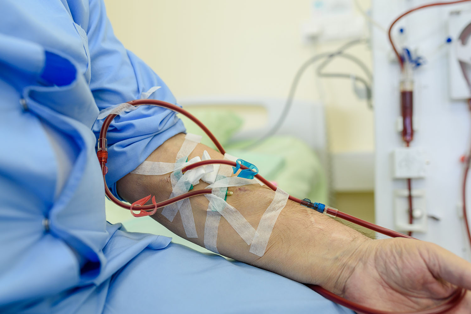 AV Fistula Opening for Dialysis