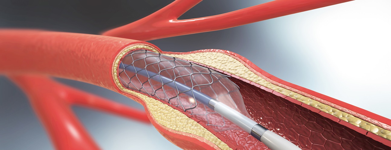 Angioplasty and Stenting
