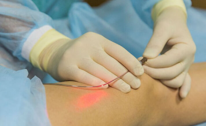  Endovenous Laser Treatment (EVLT)