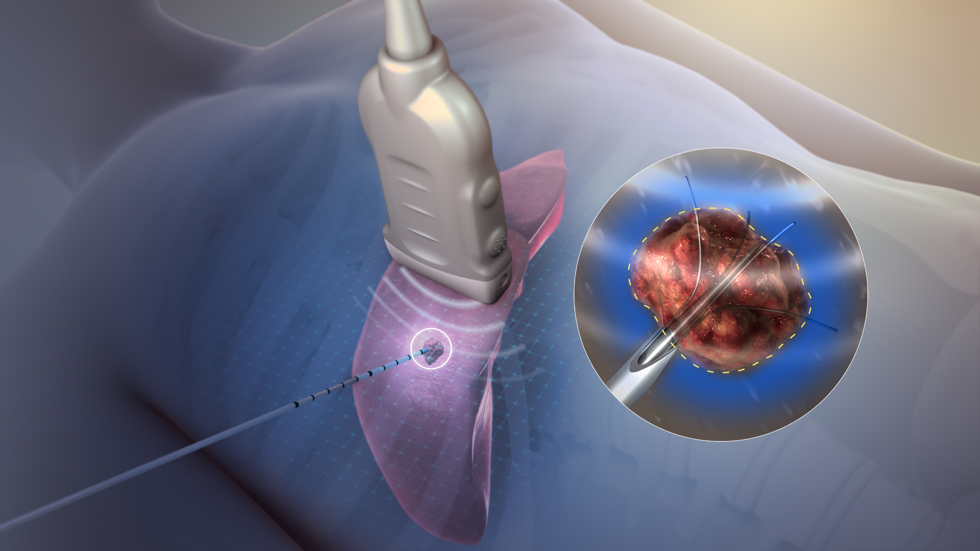  Radiofrequency Ablation (RFA)