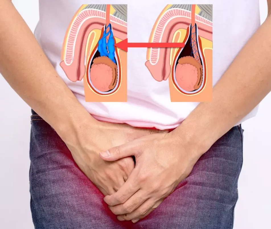 Varicocele Treatment