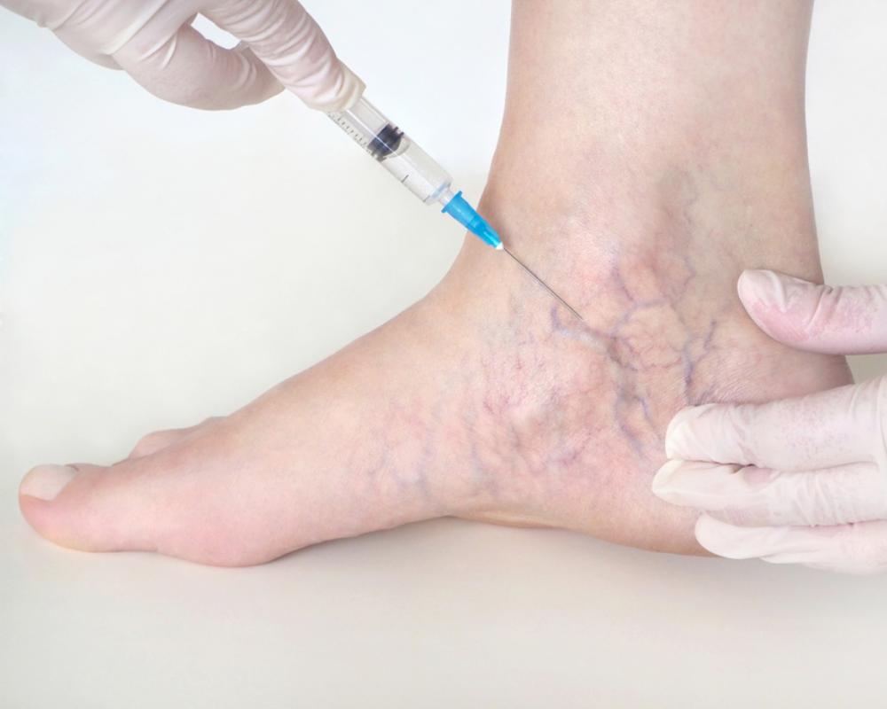 Sclerotherapy
