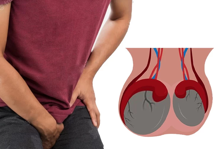 Varicocele Treatment