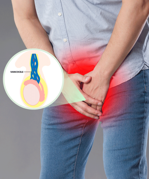 Varicocele Treatment