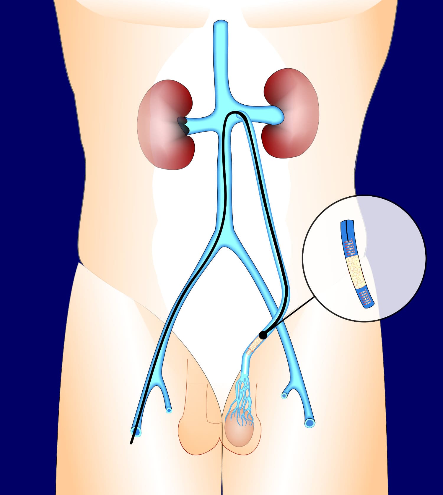 Varicocele Treatment (Embolization)