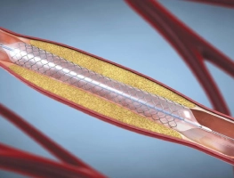 Angioplasty and Stenting