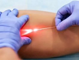 Endovenous Laser Treatment (EVLT)
