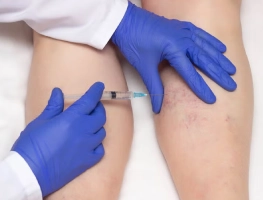 Sclerotherapy