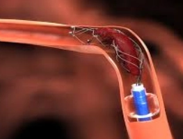 Thrombectomy (Clot Removal)