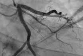 Angiography (Digital Subtraction Angiography)