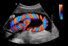 Colour Doppler Ultrasound