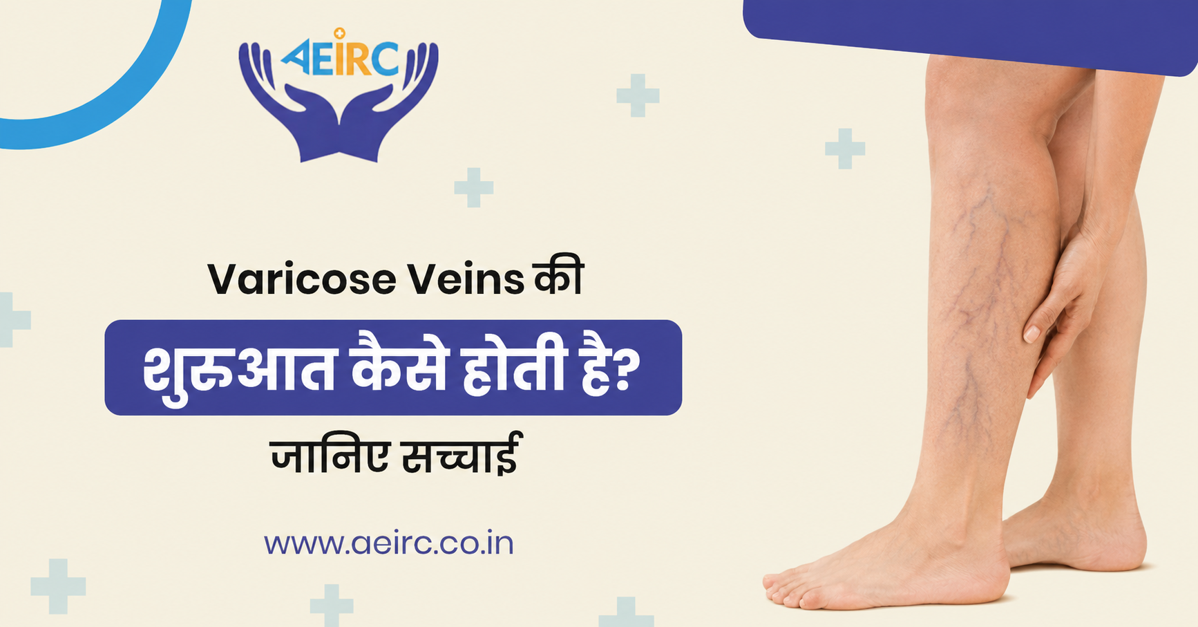 Varicose Veins की शुरुआत कैसे होती है?
