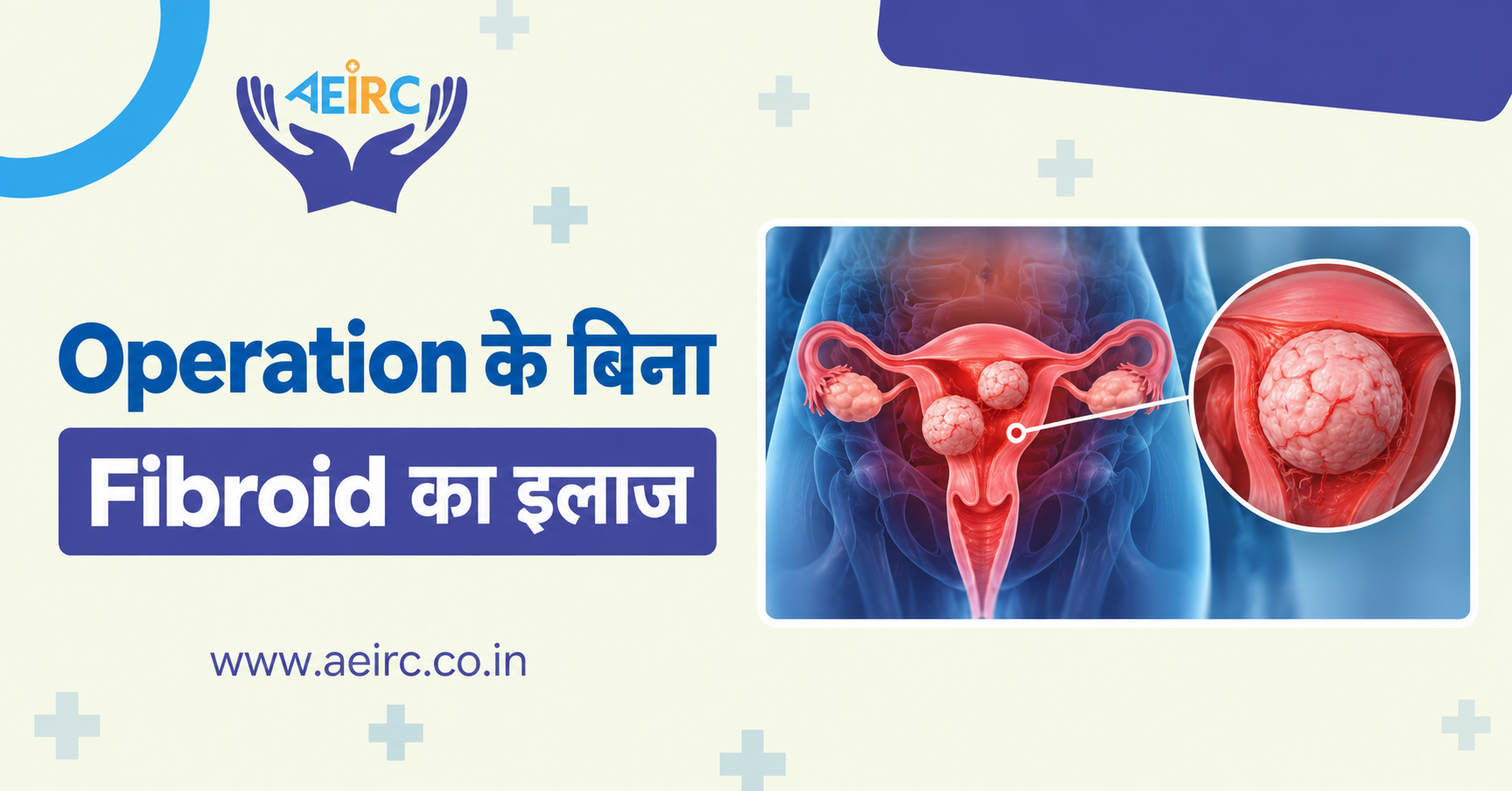 Operation के बिना Fibroid का इलाज