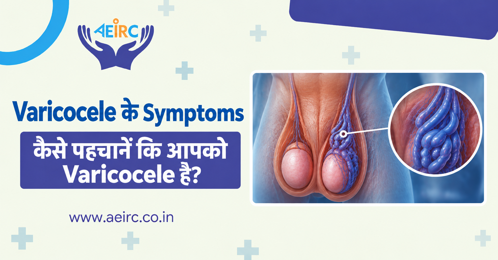 Varicocele के Symptoms: कैसे पहचानें कि आपको Varicocele है?